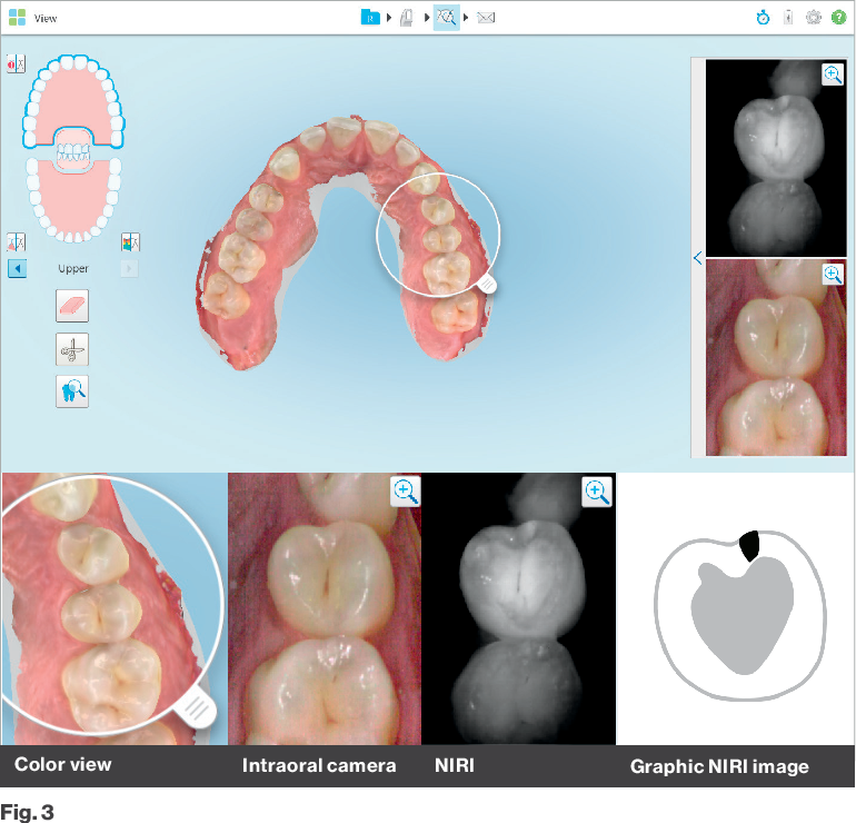 ClinCheck iTero Element 5D